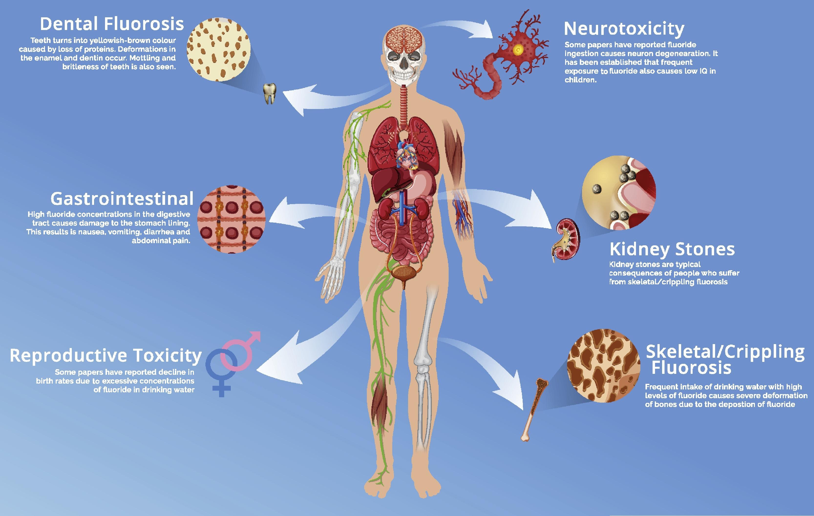 Fluoride Toxicity